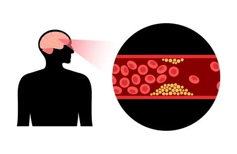 Brain stroke ishemic Stock Illustration