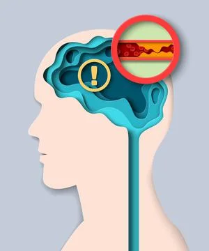 Brain stroke medical vector with human disease Stock Illustration