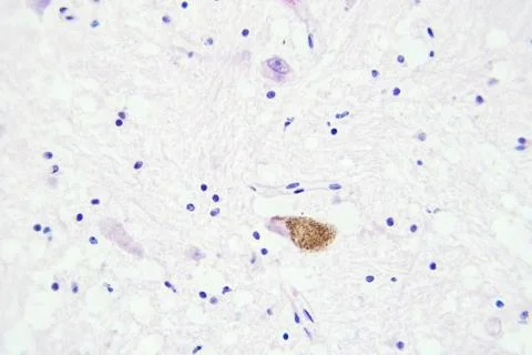 Brain tissue microscopic view magnification x400 Stock Photos