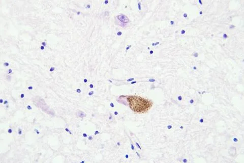 Brain tissue microscopic view magnification x400 Stock Photos