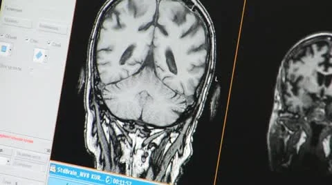 Brain tomogram Stock Footage 12140176