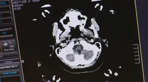 Brain tomogram 스톡 동영상 12140204