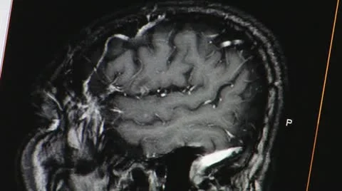 Brain tomogram 動画素材 12140247