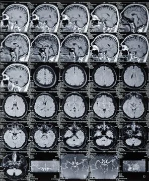 Brain tomograma Foto stock