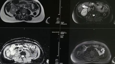 Brain tomography on MRI scan. Stock Footage