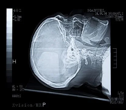 Brain tomography. Stock Photos