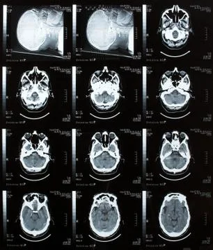 Brain tomography. Stock Photos