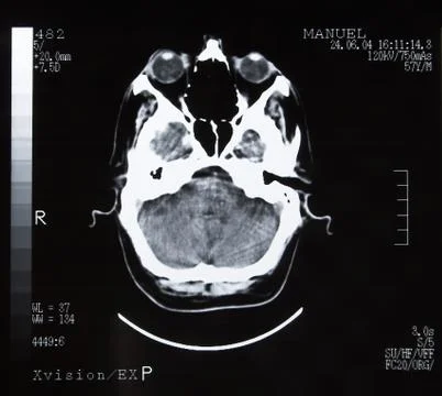 Brain tomography. Stock Photos