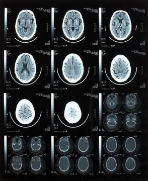 Brain tomography. Stock Photos