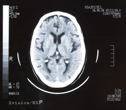 Brain tomography. Stock Photos