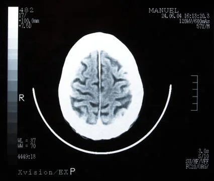 Brain tomography. Stock Photos