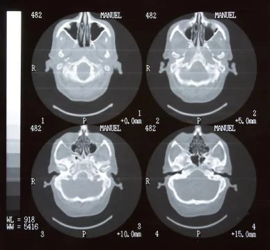 Brain tomography. Stock Photos
