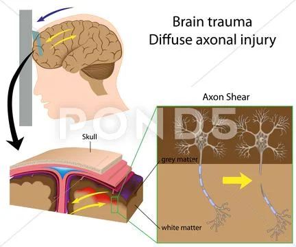 Brain trauma with axon shear Stock Illustration