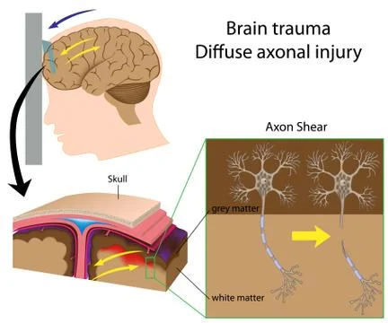 Brain trauma with axon shear Stock Illustration