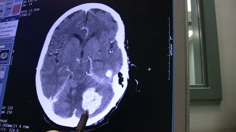 Brain Tumor On Cat Scan Stock Footage