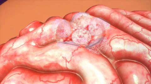 Brain tumor Stock Illustration