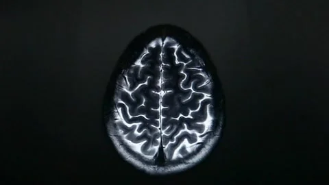 Brain tumor MRI scan performed medical imaging technique using magnetic field Stock Footage 336561131