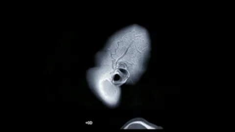 Brain tumor MRI scan performed medical imaging technique using magnetic field 库存影片 336569205