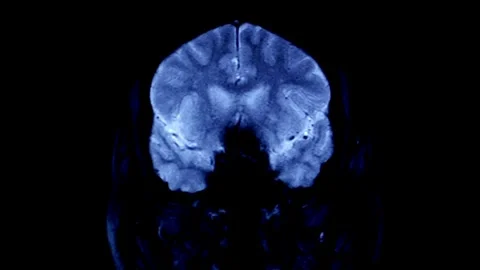 Brain tumor MRI scan performed medical imaging technique using magnetic field 스톡 동영상 336569219