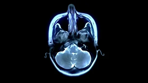 Brain tumor MRI scan performed medical imaging technique using magnetic field 스톡 동영상 336569359