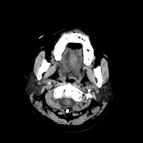 Brain tumour, CT scan Stock Footage