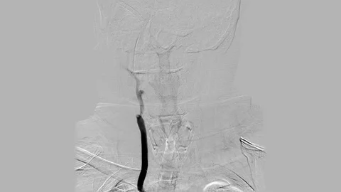 Brain vessels angiography | Grey colored Cerebral angiogram. Stock Footage 89748274