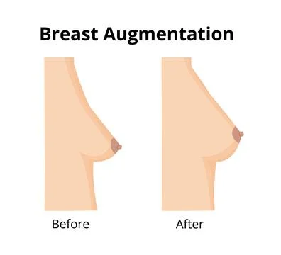 Breast augmentation before after contrast showing surgery results Stock Illustration