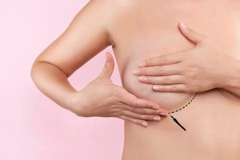 Breast augmentation Stock Illustration