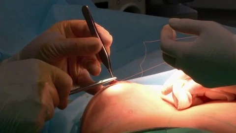Breast augmentation . operating Vidéo 75987982