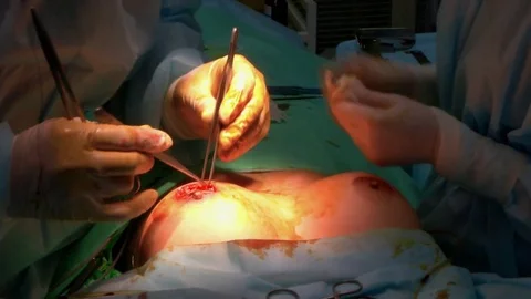 Breast augmentation operation. Stock Footage 73920678