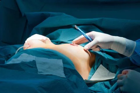 Breast augmentation Stock Photos