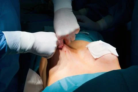 Breast augmentation Stock Photos