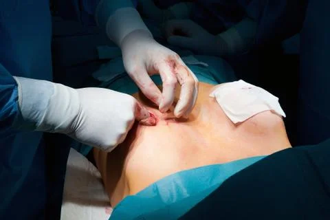 Breast augmentation Foto stock