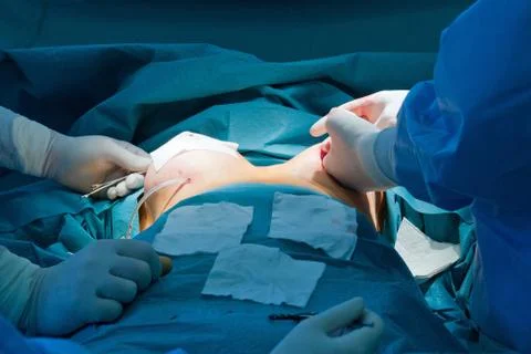 Breast augmentation Stock Photos