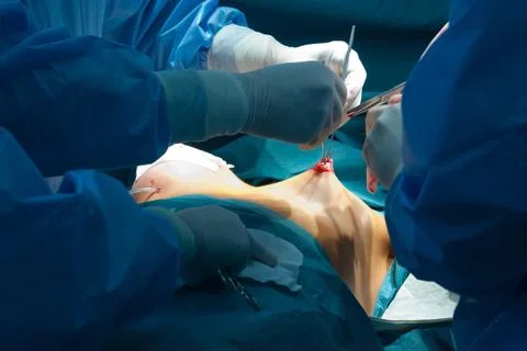 Breast augmentation Stock Photos