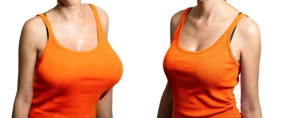 Breast augmentation Foto stock