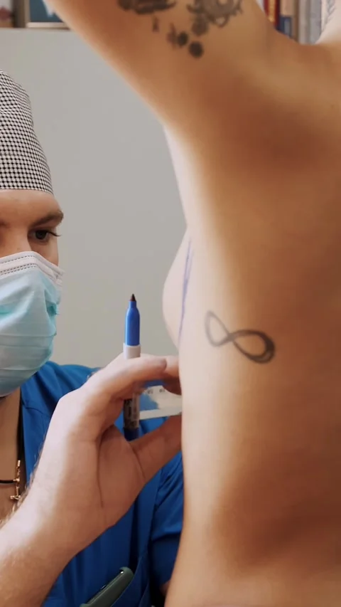 Breast augmentation plastic surgery. surgeon makes markings on patient's body Stock Footage 318462587