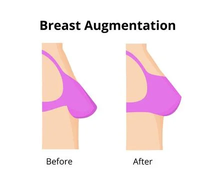 Breast augmentation showing before and after comparison Stock Illustration