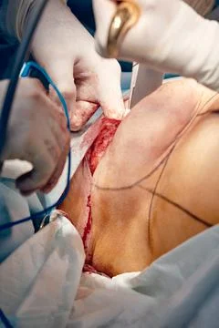 Breast augmentation, surgeon increasing the space for implant. Stock Photos