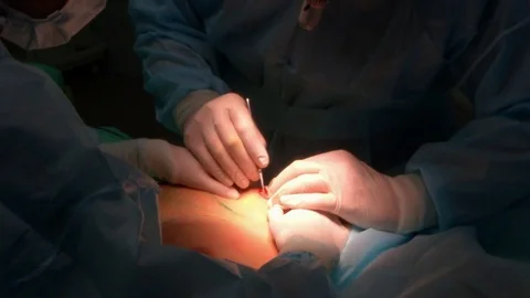 Breast augmentation surgery. The doctor cuts the chest with a scalpel Stock Footage 76079152