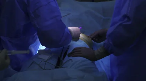 Breast augmentation surgery Vídeo Stock 61093601