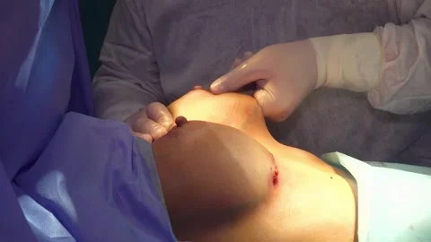 Breast augmentation surgery in the operating room surgeon tools implant. Stock Footage 259467719