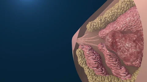 Breast cancer cell growth animation. Stock Footage