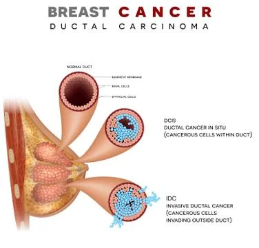 Breast cancer Stock Illustration