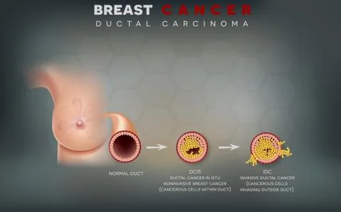 Breast cancer Illustrazione stock