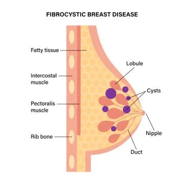 Breast disease concept イラスト素材