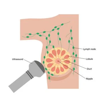 Breast disease concept Stock Illustration