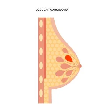Breast disease concept Illustrazione stock