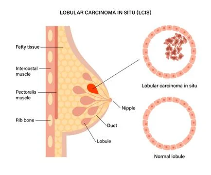 Breast disease concept Stock Illustration