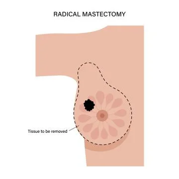Breast disease concept Stock Illustration